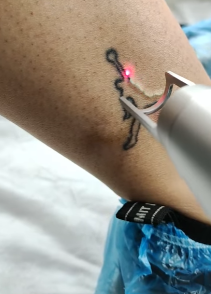 penghapusan tato menggunakan laser